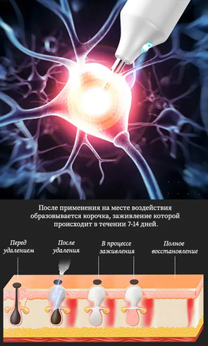 Коагулятор плазменный, Plasma Pen/Электрокоагулятор/Беспроводная ручка для удаления папиллом и бородавок