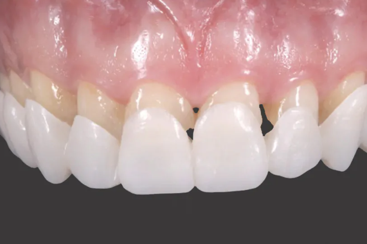 Вініри для зубів верх Snap On Smile
