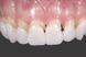 Вініри для зубів верх Snap On Smile